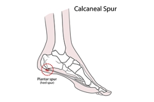 Bone Spurs on the Feet