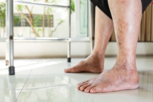 Caring for Feet Affected by Systemic Diseases