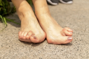 Rheumatoid Arthritis in the Foot and How a Podiatrist Can Help